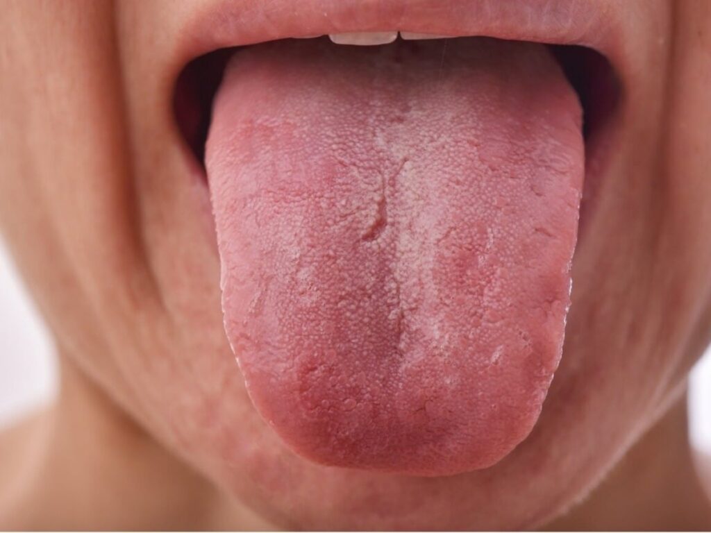 Discover What Your Tongue Color Reveals About Your Health