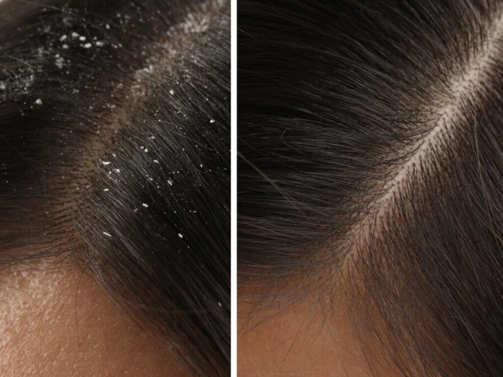 Banish Winter Dandruff with Egg and Yogurt Hair Mask!